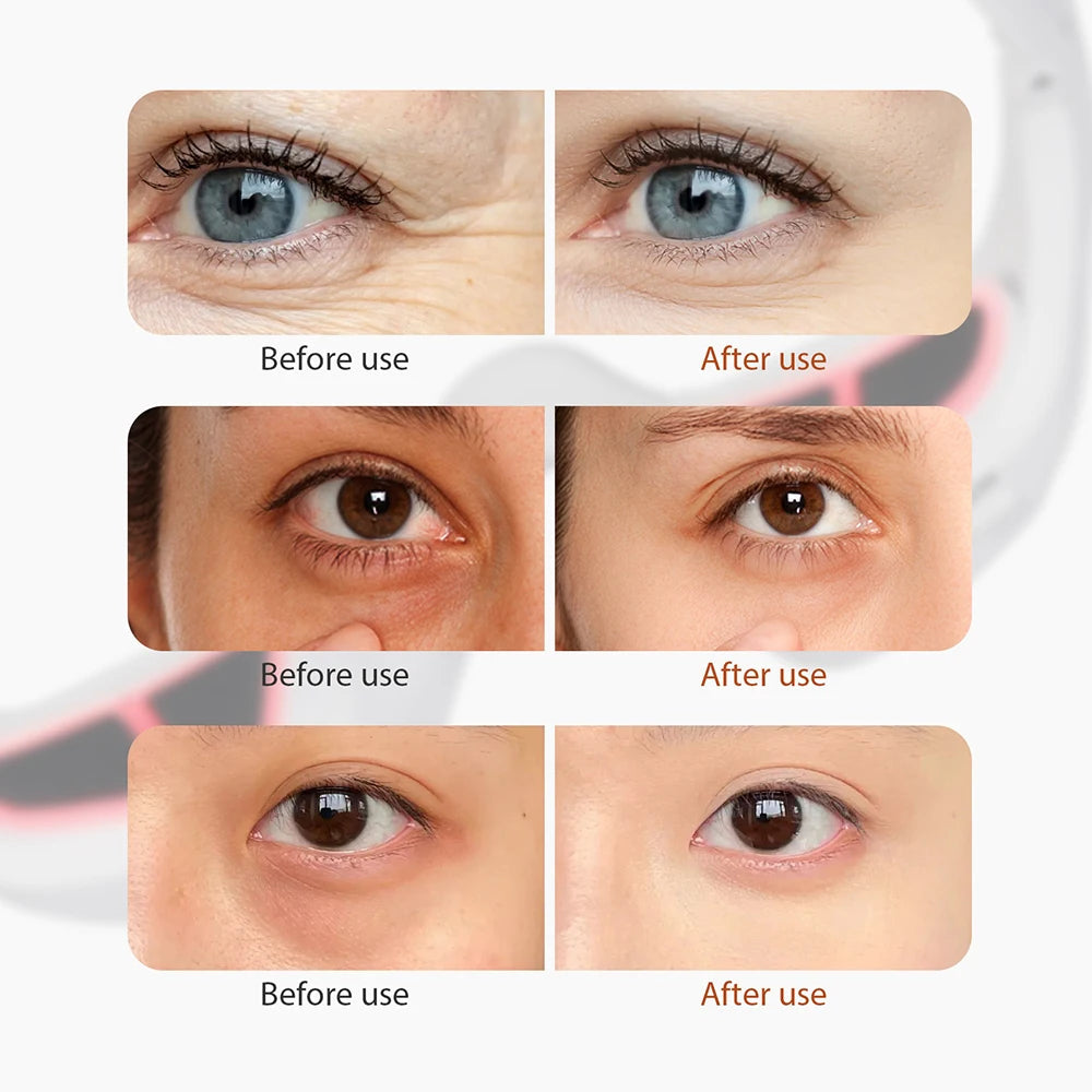 Massageador de Olhos - Revitaleyes Ardilis